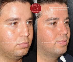 Rinoplastia - Fasent. Dr Rolando de la Garza Giacomán