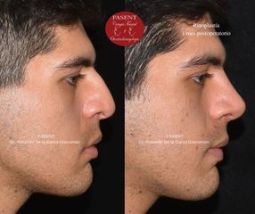 Rinoplastia - Fasent. Dr Rolando de la Garza Giacomán