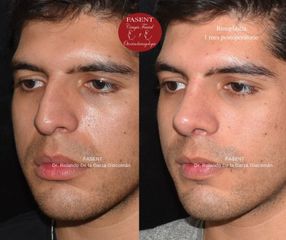 Rinoplastia - Fasent. Dr Rolando de la Garza Giacomán