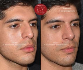 Rinoplastia - Fasent. Dr Rolando de la Garza Giacomán