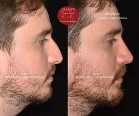 Rinoplastia - Fasent. Dr Rolando de la Garza Giacomán