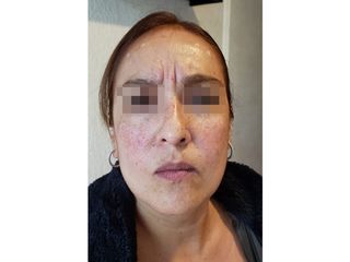 toxina botulínica
