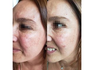 Antes y después de toxina botulínica