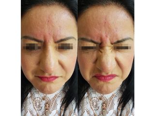 Antes y después de toxina botulínica