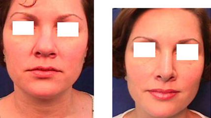 Antes y después de Rinoplastia