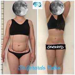 Mini Lipoescultura - Dr. Gerardo Rubio