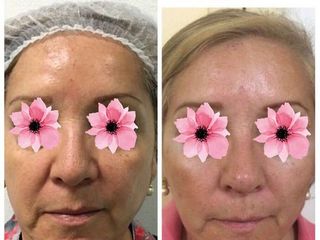 Antes y después de Plasma rico en plaquetas+Radiofrecuencia 
