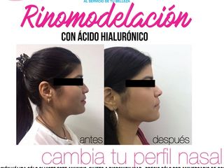 Antes y despues de rinomodelacion