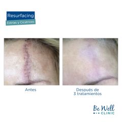 Antes y después de Resurfacing Venus Viva | Cicatrices 