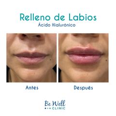 Antes y después de Rellenos Ácido Hialurónico | Ácido Hialurónico