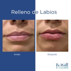 Antes y después de Rellenos Ácido Hialurónico | Ácido Hialurónico