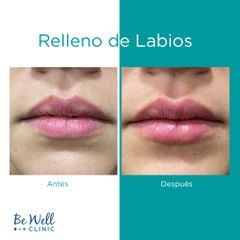 Antes y después de Rellenos Ácido Hialurónico | Ácido Hialurónico