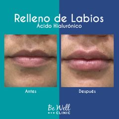 Antes y después de Rellenos Ácido Hialurónico 