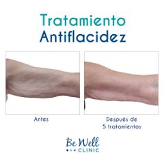 Antes y después de Antiflacidez | Venus Legacy