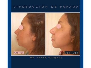 Antes y después de Liposucción de papada 