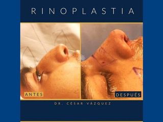 Antes y después de Rinoplastia