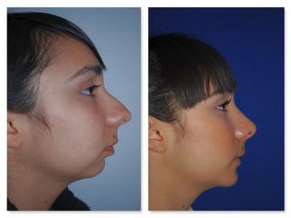 Antes y después de Mentoplastia