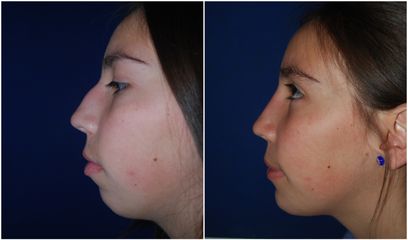 Antes y después de Rinoplastia + Mentoplastia 