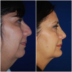 Antes y después de Rinoplastia + Mentoplastia 