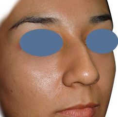 Rinoplastia  