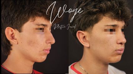 Otoplastia y Rinoplastia -Dr. Carlos Woge