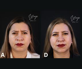 Botox - Dr. Carlos Woge