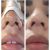 Próxima rinoplastia el 20 de Noviembre 2020