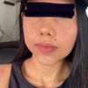 Punta de nariz desviada después de rinoplastia