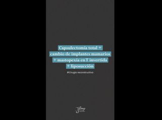 Mastopexia - Dr. Jhony Camarero